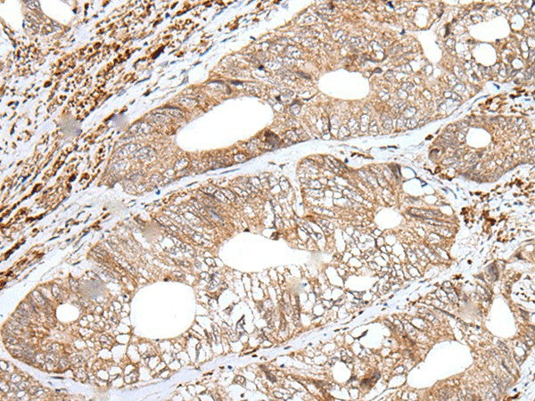 Immunohistochemistry of paraffin-embedded Human colorectal cancer tissue using ENPEP Polyclonal Antibody at dilution of 1:65(×200)