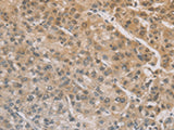 Immunohistochemistry of paraffin-embedded Human liver cancer tissue using ZIC2 Polyclonal Antibody at dilution of 1:100(×200)