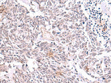 Immunohistochemistry of paraffin-embedded Human lung cancer tissue using TRMT12 Polyclonal Antibody at dilution of 1:85(×200)