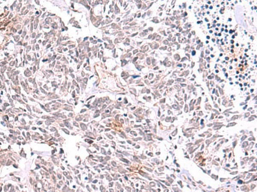 Immunohistochemistry of paraffin-embedded Human lung cancer tissue using TRMT12 Polyclonal Antibody at dilution of 1:85(×200)