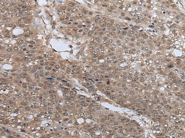 Immunohistochemistry of paraffin-embedded Human liver cancer tissue using UBE4B Polyclonal Antibody at dilution of 1:40(×200)
