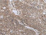 Immunohistochemistry of paraffin-embedded Human liver cancer tissue using UBE4B Polyclonal Antibody at dilution of 1:40(×200)