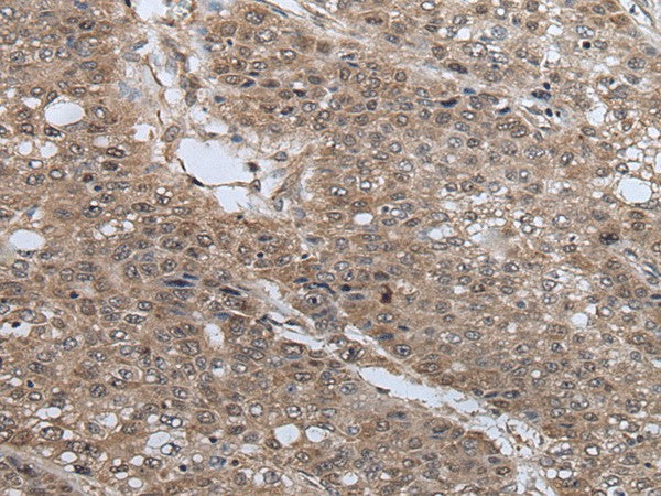 Immunohistochemistry of paraffin-embedded Human liver cancer tissue using UBE4B Polyclonal Antibody at dilution of 1:40(×200)