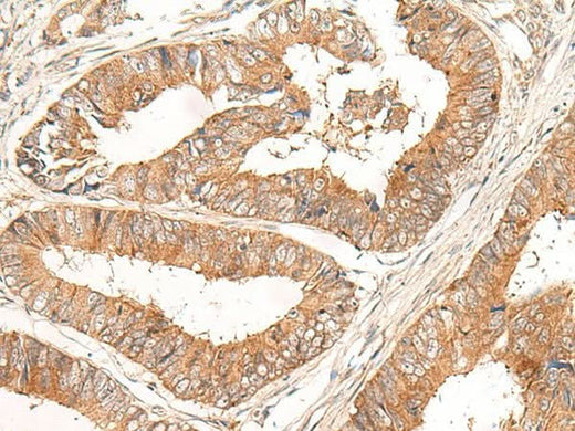 Immunohistochemistry of paraffin-embedded Human colorectal cancer tissue using CORO2A Polyclonal Antibody at dilution of 1:30(×200)