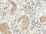 Immunohistochemistry of paraffin-embedded Human esophagus cancer tissue using SNRPG Polyclonal Antibody at dilution of 1:40(×200)