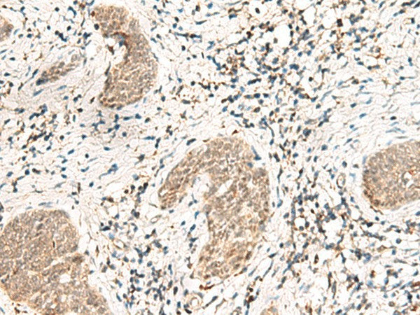Immunohistochemistry of paraffin-embedded Human esophagus cancer tissue using SNRPG Polyclonal Antibody at dilution of 1:40(×200)
