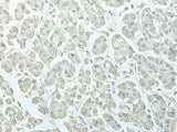 Immunohistochemistry of paraffin-embedded Human gastric cancer tissue using C8orf4 Polyclonal Antibody at dilution of 1:55(×200)
