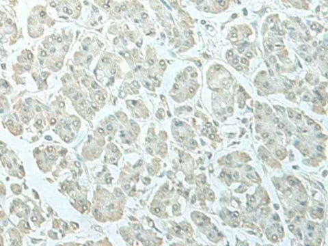 Immunohistochemistry of paraffin-embedded Human gastric cancer tissue using C8orf4 Polyclonal Antibody at dilution of 1:55(×200)