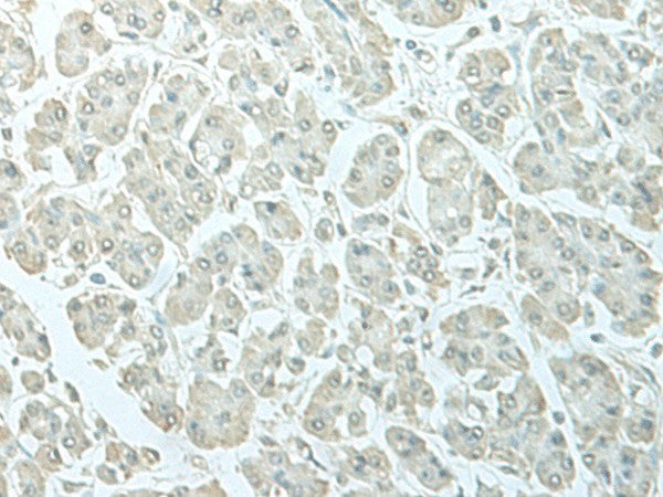 Immunohistochemistry of paraffin-embedded Human gastric cancer tissue using C8orf4 Polyclonal Antibody at dilution of 1:55(×200)