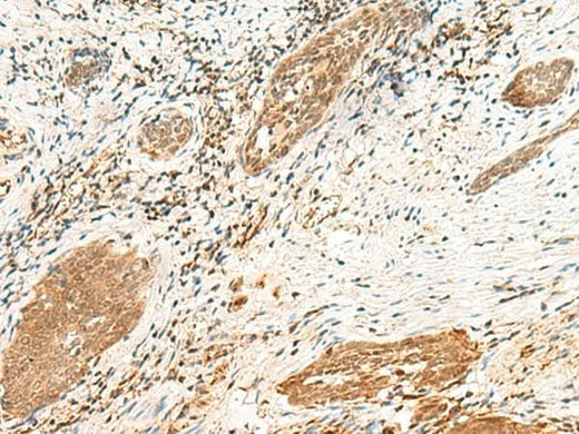 Immunohistochemistry of paraffin-embedded Human esophagus cancer tissue using POLR1D Polyclonal Antibody at dilution of 1:50(×200)