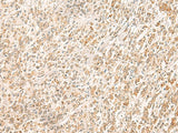 Immunohistochemistry of paraffin-embedded Human gastric cancer tissue using MYCT1 Polyclonal Antibody at dilution of 1:35(×200)