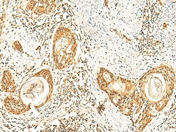 Immunohistochemistry of paraffin-embedded Human esophagus cancer tissue using ZNF580 Polyclonal Antibody at dilution of 1:75(×200)