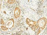Immunohistochemistry of paraffin-embedded Human esophagus cancer tissue using ZNF580 Polyclonal Antibody at dilution of 1:75(×200)