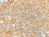 Immunohistochemistry of paraffin-embedded Human liver cancer tissue using PAFAH1B2 Polyclonal Antibody at dilution of 1:50(×200)