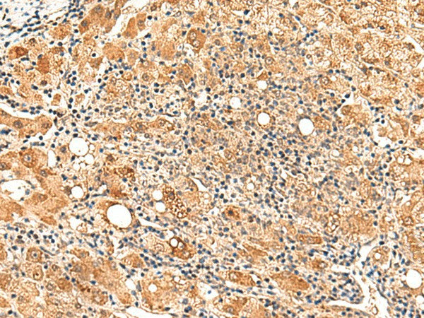 Immunohistochemistry of paraffin-embedded Human liver cancer tissue using PAFAH1B2 Polyclonal Antibody at dilution of 1:50(×200)