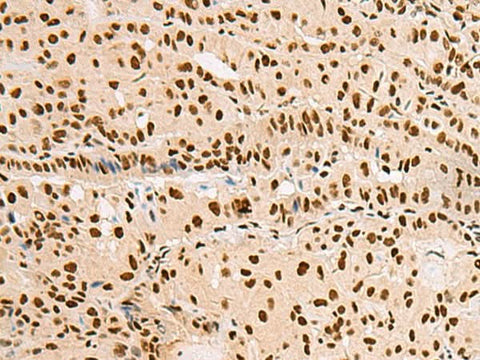 Immunohistochemistry of paraffin-embedded Human thyroid cancer tissue using XRCC4 Polyclonal Antibody at dilution of 1:60(×200)