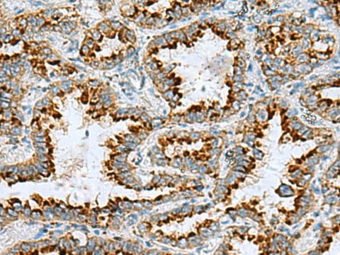 Immunohistochemistry of paraffin-embedded Human lung cancer tissue using FAAP100 Polyclonal Antibody at dilution of 1:85(×200)