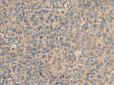 Immunohistochemistry of paraffin-embedded Human cervical cancer tissue using AHNAK Polyclonal Antibody at dilution of 1:50(×200)