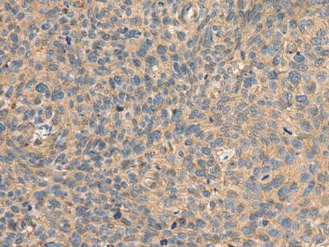 Immunohistochemistry of paraffin-embedded Human cervical cancer tissue using AHNAK Polyclonal Antibody at dilution of 1:50(×200)