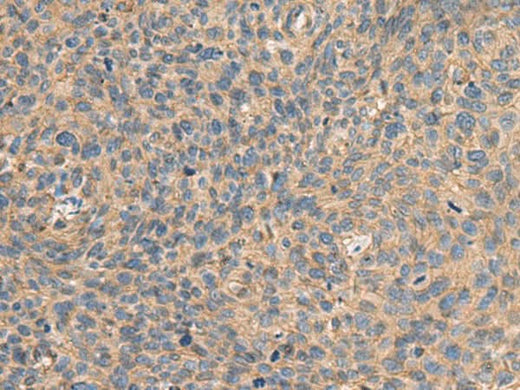Immunohistochemistry of paraffin-embedded Human cervical cancer tissue using AHNAK Polyclonal Antibody at dilution of 1:50(×200)