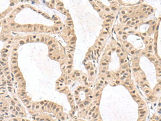 Immunohistochemistry of paraffin-embedded Human thyroid cancer tissue using RPS6KA5 Polyclonal Antibody at dilution of 1:170(×200)
