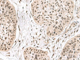 Immunohistochemistry of paraffin-embedded Human esophagus cancer tissue using ERH Polyclonal Antibody at dilution of 1:55(×200)