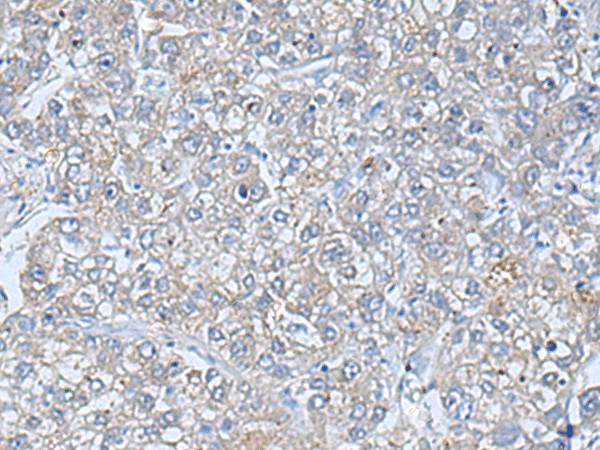 Immunohistochemistry of paraffin-embedded Human liver cancer tissue using TREM1 Polyclonal Antibody at dilution of 1:50(×200)