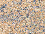 Immunohistochemistry of paraffin-embedded Human liver cancer tissue using PTH1R Polyclonal Antibody at dilution of 1:55(×200)
