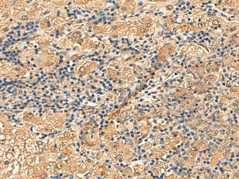 Immunohistochemistry of paraffin-embedded Human liver cancer tissue using PTH1R Polyclonal Antibody at dilution of 1:55(×200)