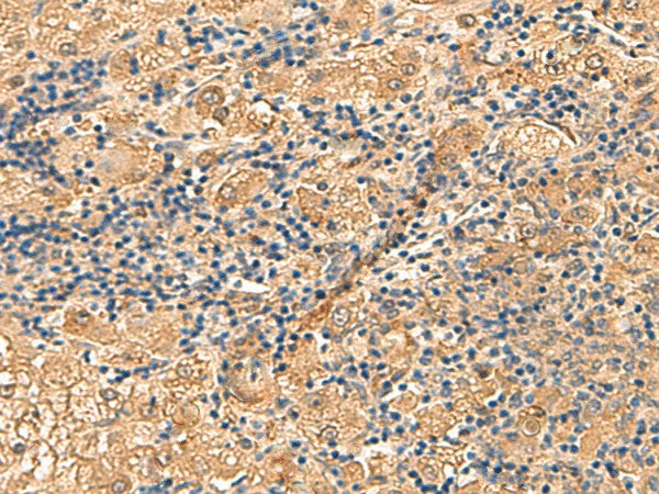 Immunohistochemistry of paraffin-embedded Human liver cancer tissue using PTH1R Polyclonal Antibody at dilution of 1:55(×200)