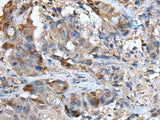 Immunohistochemistry of paraffin-embedded Human breast cancer tissue using CXCL5 Polyclonal Antibody at dilution of 1:50(×200)