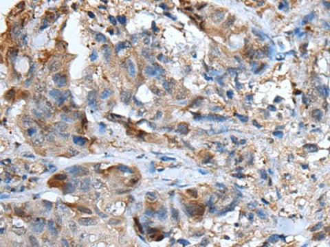 Immunohistochemistry of paraffin-embedded Human breast cancer tissue using CXCL5 Polyclonal Antibody at dilution of 1:50(×200)