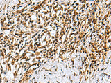 Immunohistochemistry of paraffin-embedded Human esophagus cancer tissue using KDM2B Polyclonal Antibody at dilution of 1:40(×200)