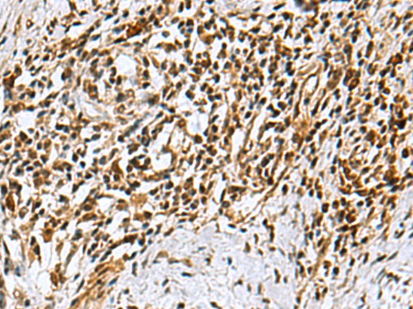 Immunohistochemistry of paraffin-embedded Human esophagus cancer tissue using KDM2B Polyclonal Antibody at dilution of 1:40(×200)