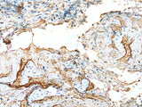 Immunohistochemistry of paraffin-embedded Human cervical cancer tissue using LDHD Polyclonal Antibody at dilution of 1:120(×200)