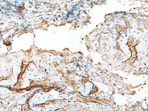 Immunohistochemistry of paraffin-embedded Human cervical cancer tissue using LDHD Polyclonal Antibody at dilution of 1:120(×200)