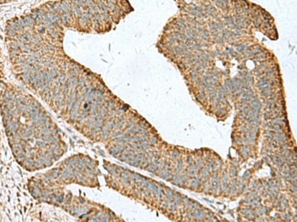 Immunohistochemistry of paraffin-embedded Human colorectal cancer tissue using CDC20 Polyclonal Antibody at dilution of 1:50(×200)