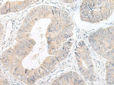 Immunohistochemistry of paraffin-embedded Human colorectal cancer tissue using LYRM2 Polyclonal Antibody at dilution of 1:50(×200)