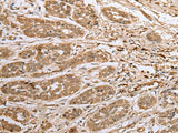 Immunohistochemistry of paraffin-embedded Human esophagus cancer tissue using ATXN7L3 Polyclonal Antibody at dilution of 1:40(×200)