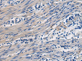 Immunohistochemistry of paraffin-embedded Human colorectal cancer tissue using COL17A1 Polyclonal Antibody at dilution of 1:50(×200)