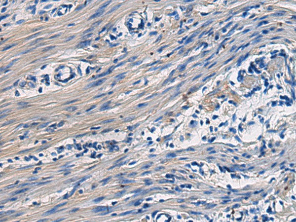Immunohistochemistry of paraffin-embedded Human colorectal cancer tissue using COL17A1 Polyclonal Antibody at dilution of 1:50(×200)