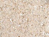 Immunohistochemistry of paraffin-embedded Human ovarian cancer tissue using NUP210 Polyclonal Antibody at dilution of 1:30(×200)