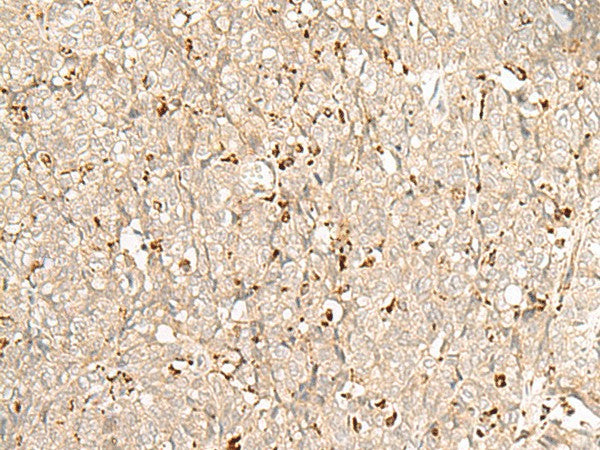 Immunohistochemistry of paraffin-embedded Human ovarian cancer tissue using NUP210 Polyclonal Antibody at dilution of 1:30(×200)