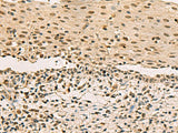 Immunohistochemistry of paraffin-embedded Human cervical cancer tissue using LRIF1 Polyclonal Antibody at dilution of 1:70(×200)