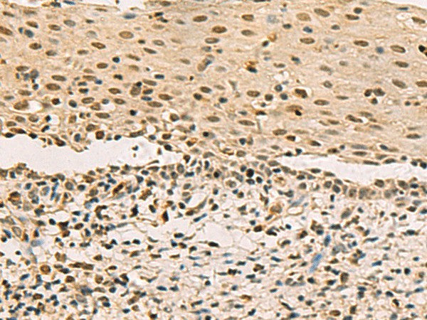 Immunohistochemistry of paraffin-embedded Human cervical cancer tissue using LRIF1 Polyclonal Antibody at dilution of 1:70(×200)