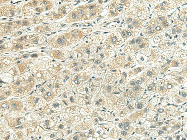 Immunohistochemistry of paraffin-embedded Human liver cancer tissue using RHBDL2 Polyclonal Antibody at dilution of 1:140(×200)