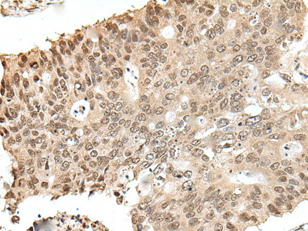 Immunohistochemistry of paraffin-embedded Human colorectal cancer tissue using ZNF410 Polyclonal Antibody at dilution of 1:40(×200)