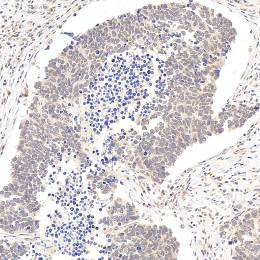 Immunohistochemistry analysis of paraffin-embedded human lung cancer using ATF6 Polyclonal Antibody at dilution of 1:400.