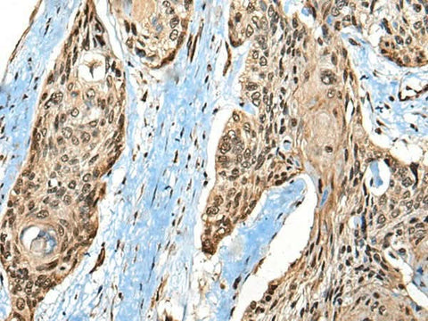 Immunohistochemistry of paraffin-embedded Human esophagus cancer tissue using CASK Polyclonal Antibody at dilution of 1:65(×200)