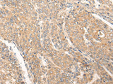 Immunohistochemistry of paraffin-embedded Human liver cancer tissue using PIAS3 Polyclonal Antibody at dilution of 1:40(×200)